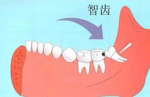 口腔智齿,智齿拔除后怎么处理智齿