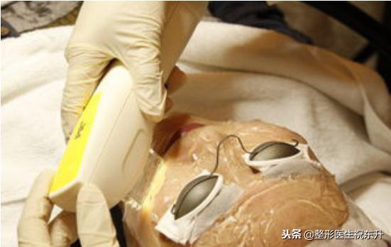 光子嫩肤敏感皮肤能做吗,光子嫩肤做了皮肤敏感