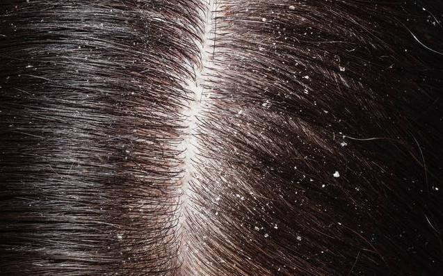 硫磺皂洗头发半年,女子用硫磺洗头坚持一年