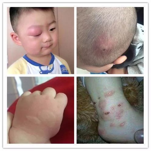 蚊子痒最佳止痒方法,宝宝被蚊子咬了怎么止痒最快