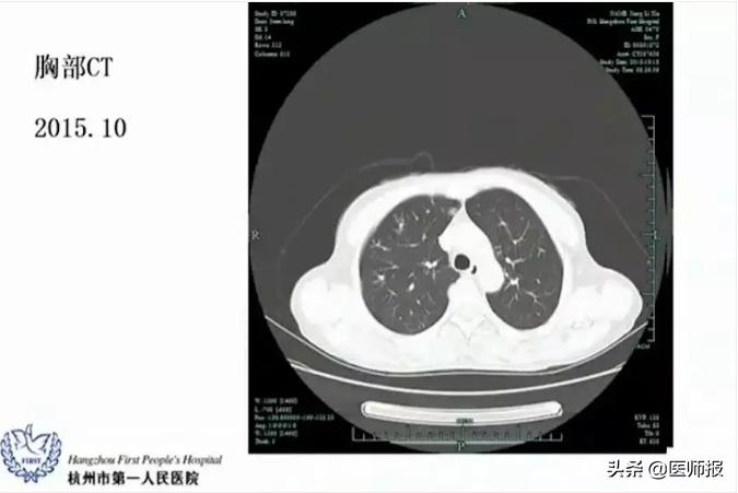 反复咳血持续一年了是肺癌吗,反复咳嗽有痰是肺炎的前兆吗