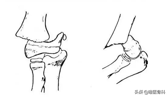 胳膊肘错位肘内翻,先天肘内翻有办法改善吗