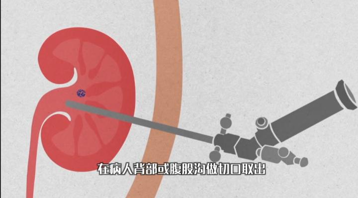 为什么肾结石掉下来肾里还有结石,肾下盏结石排石的正确方法