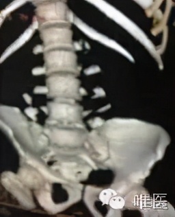 尾骶骨骨折错位突出怎么办,骶骨骨折能手法复位吗