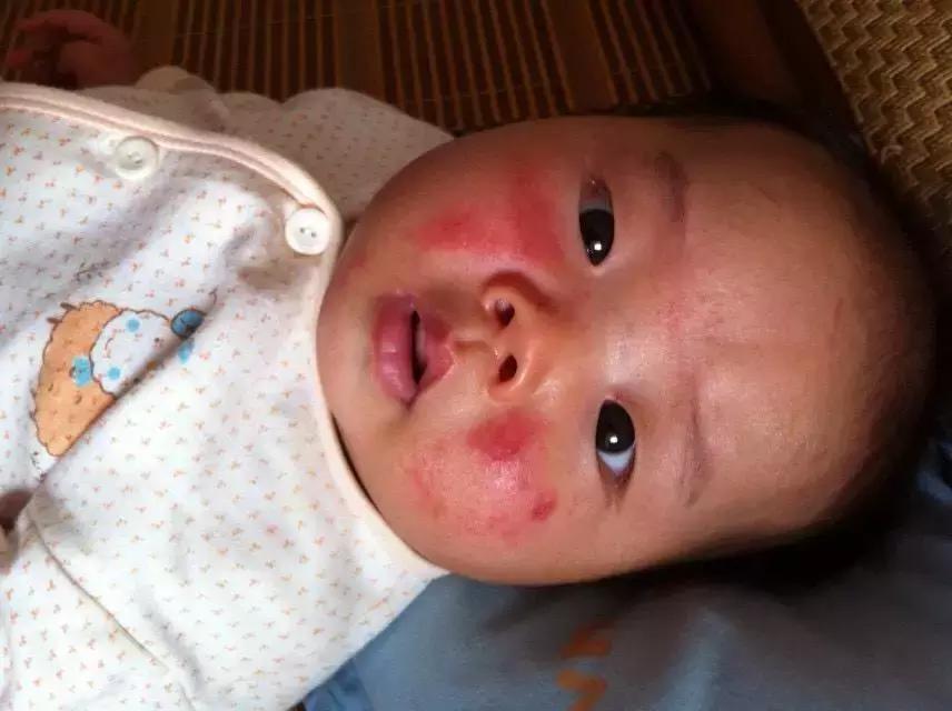宝宝湿疹有水泡的最佳治疗方法,婴幼儿湿疹反反复复一招解决