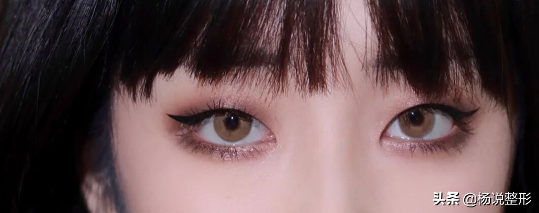 整形医生科普割双眼皮必看攻略,割双眼皮一定好看吗