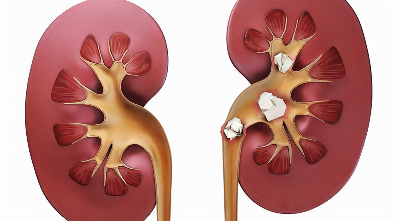 女性突然尿出鲜血来?原因主要有这三点