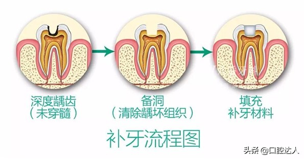 后牙选什么材料补牙,补牙材料太多啦感觉牙不舒服