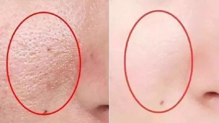 脸上螨虫多出油厉害怎么办,脸上螨虫过敏烂脸