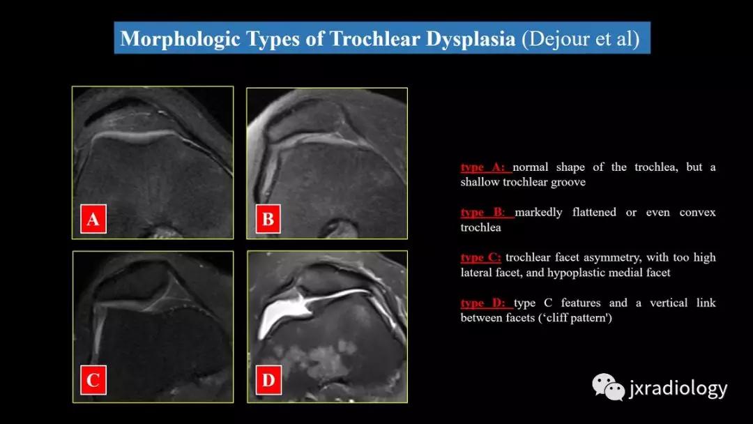 髌股关节失常磁共振看什么,髌股关节混乱的影像评估