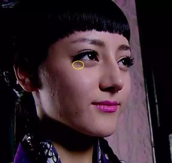 脂肪粒应该怎样用针挑,脂肪粒用针挑越挑越多