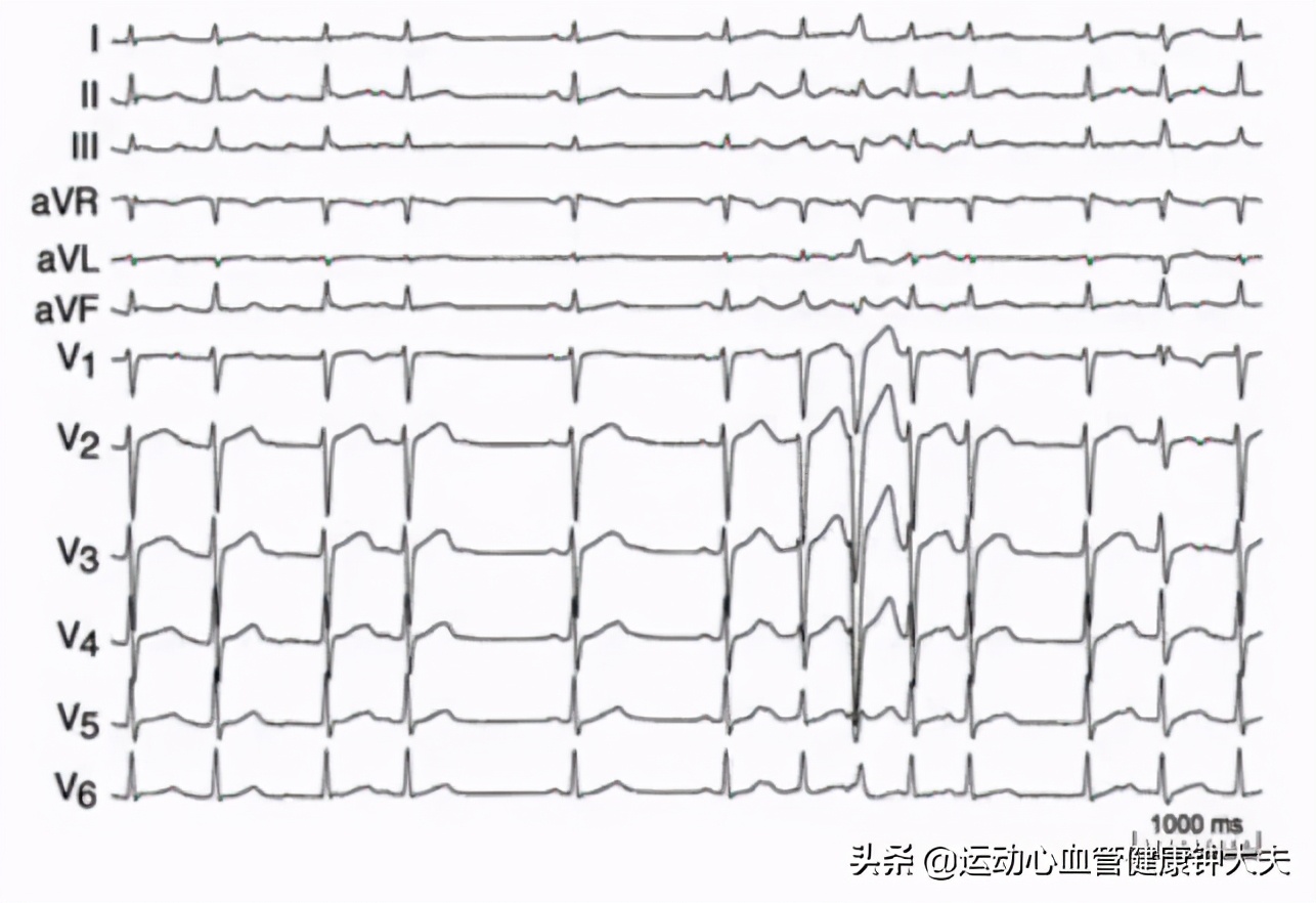 经常运动的人会不会心肌梗死,经常运动的人会得脑梗心梗吗