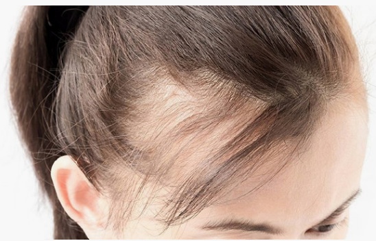 头发稀疏是毛囊坏死还是毛囊萎缩,毛囊萎缩还能长出头发吗