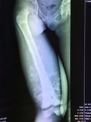 孩子腿疼结果是骨癌,14岁孩子总喊腿疼怎么回事