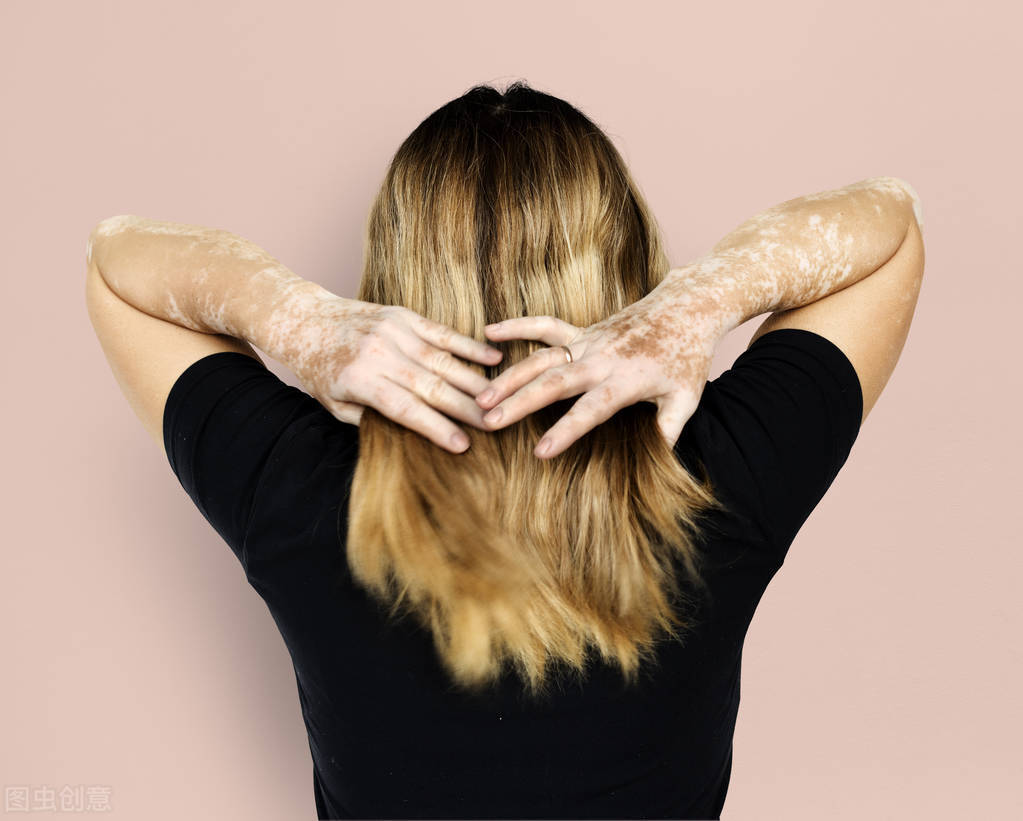 白癜风不长脸上怎么回事,白癜风不痛不痒不治疗