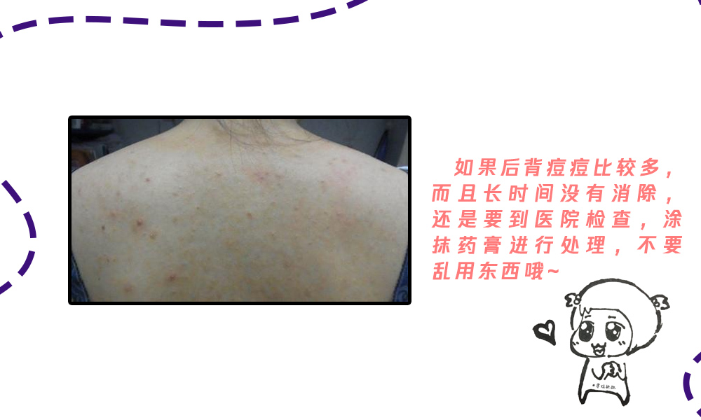 保养背部最好的方法就是开背,保养后背的十大方法