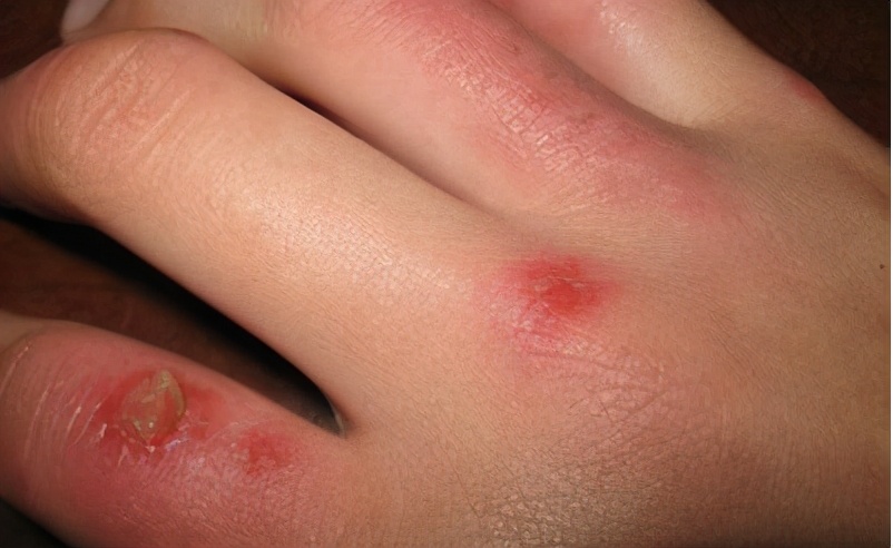 寒潮来袭怎样才能躲开冻疮,天气回暖怎么预防冻疮