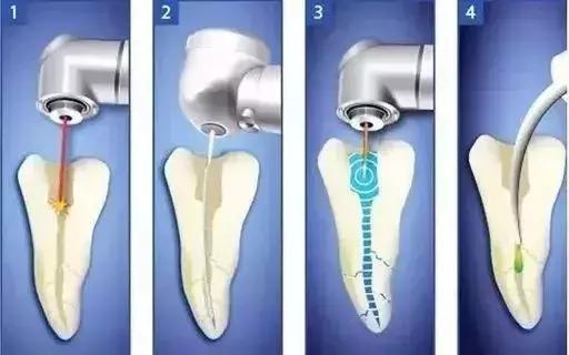 补牙医生故意把洞磨得更大,为什么医生给我补牙补得很随便