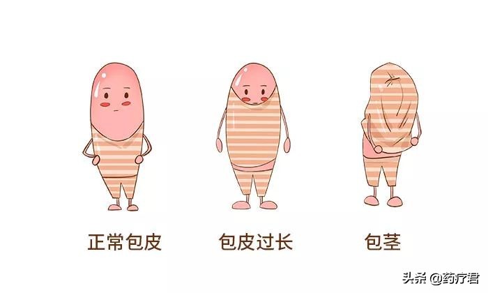 35岁男子“丁丁”被切了一部分，医生惋惜：只因包皮过长惹得祸