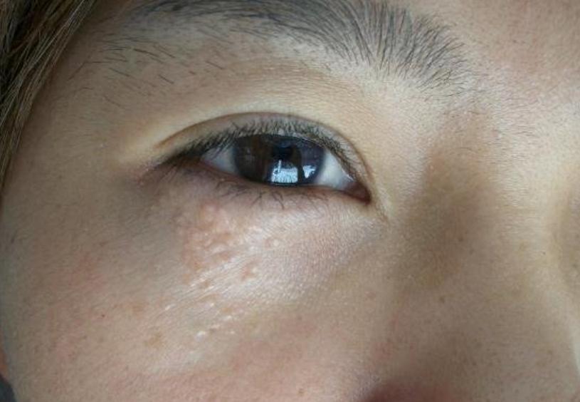 眼睛下边长的脂肪粒用什么能去掉,眼睛下面长脂肪粒去除小妙招