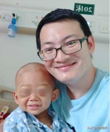 小孩摔一跤后引起眼袋淤青,2岁多男宝眼袋浮肿有点发紫