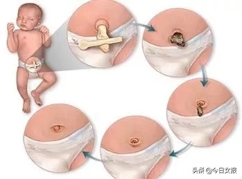 宝宝脐带不小心被拽掉了怎么包扎,脐带切断后有创面怎么办