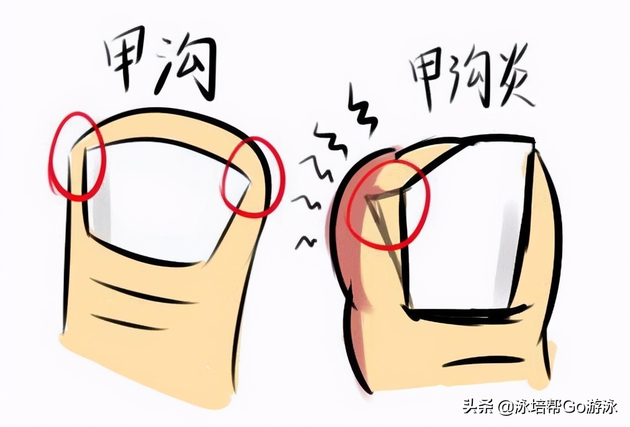 有鼻炎可以游泳治疗变异性哮喘吗,游泳改善过敏性鼻炎