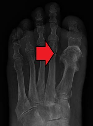 9种骶骨肿瘤,溶骨性恶性肿瘤