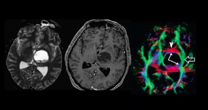磁共振dti融合成像,磁共振dti成像作用