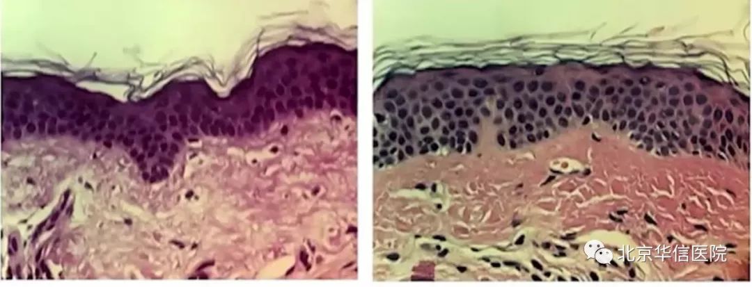 光子嫩肤帮你逆袭光滑细嫩状态,光子嫩肤让你拥有蛋壳般肌肤