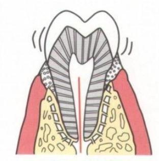 牙齿松了估计固定的会不会好,牙齿松了一年了还有救么