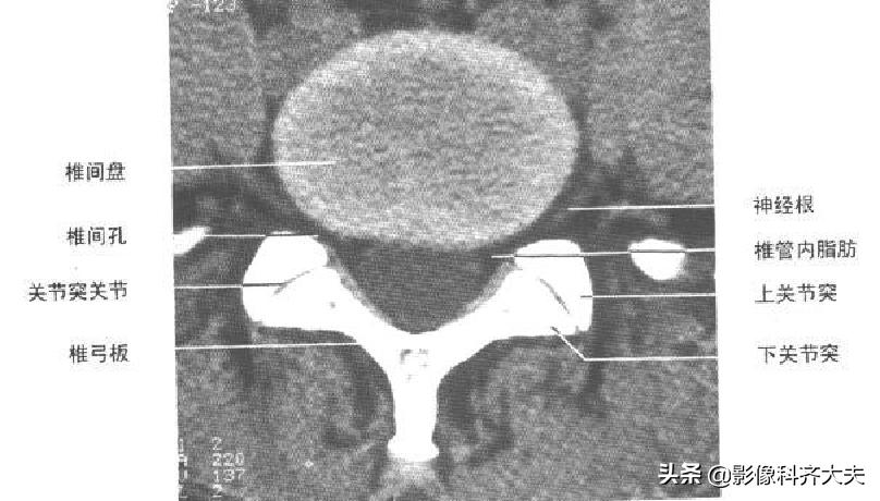 腰椎间盘突出的影像学诊断及治疗,腰椎间盘突出影像学课件