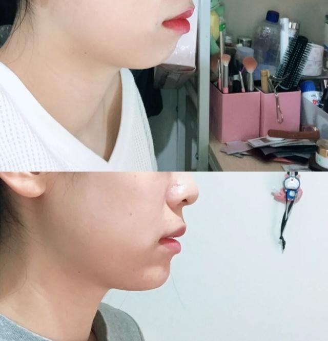 如何消除双下巴让脸型更好看,下巴松弛造成的双下巴面相