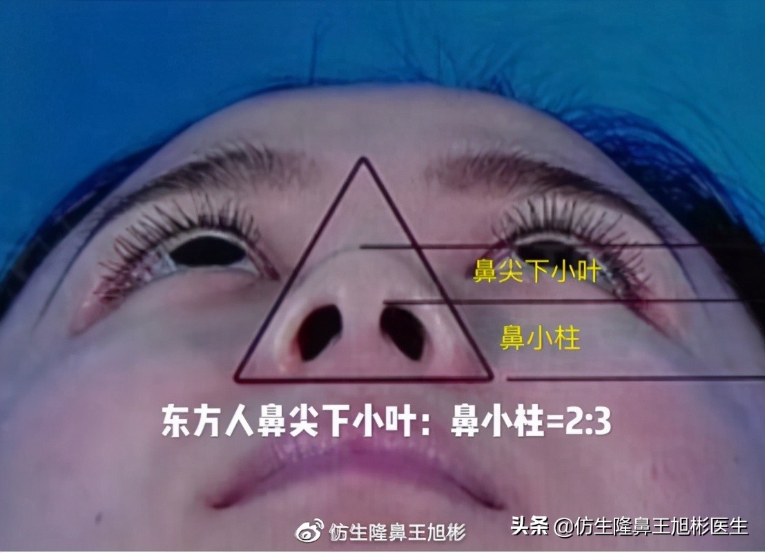 鼻翼缩小可以改善鼻翼缘后缩吗,鼻翼肥大如何正确改善