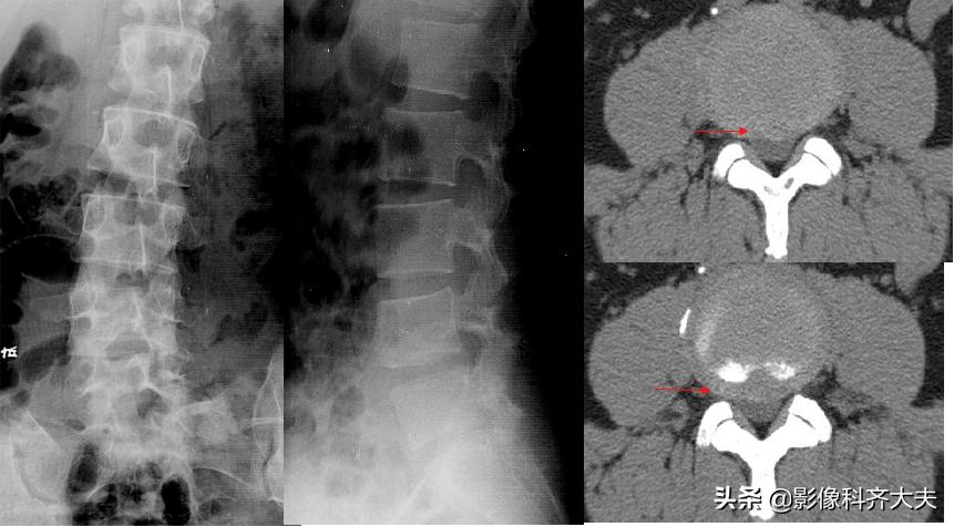 腰椎间盘突出最好的影像诊断方法,腰椎间盘突出的影像学检查