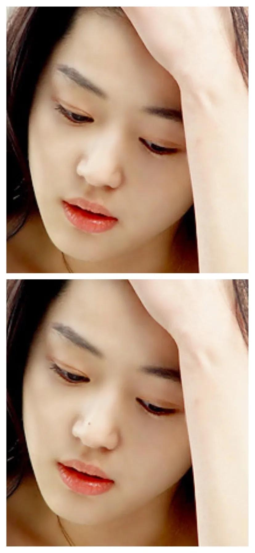 点痣就能变美,点痣整容大法