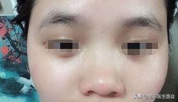 塌鼻梁、鼻根低整个鼻子趴在脸上想垫高怎么办？