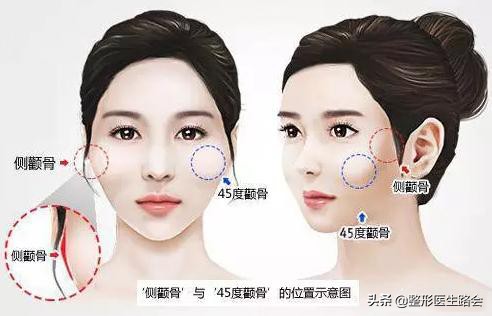 颧骨高显得老,颧骨特别高长胖会不会变好