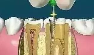 做根管治疗一定要问的问题,根管治疗为啥要做好几次