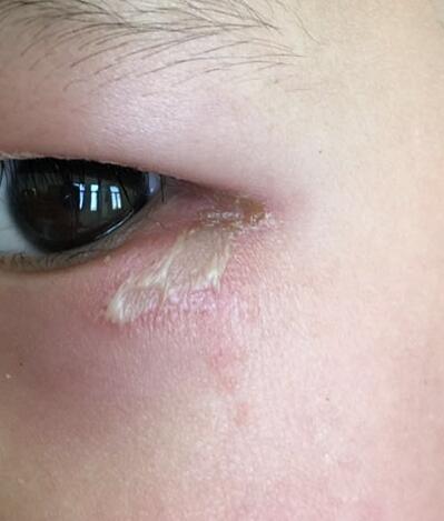 孩子被虫咬后起来了个大水泡,小孩腿被虫咬起了水泡还肿得厉害