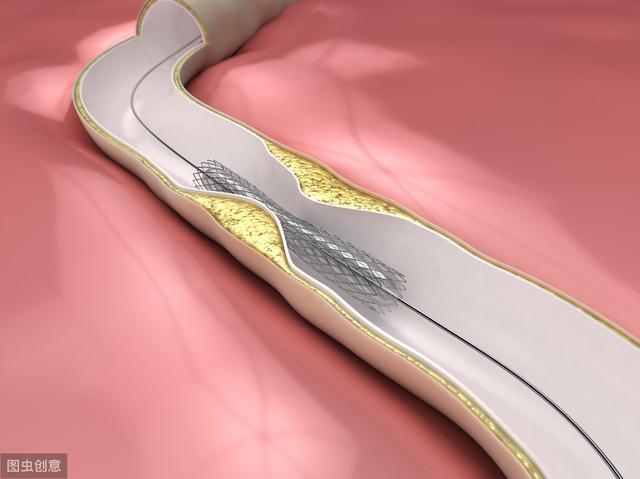 脑动脉供血不足怎么疏通,脑动脉血管堵塞90%最好的治疗方法