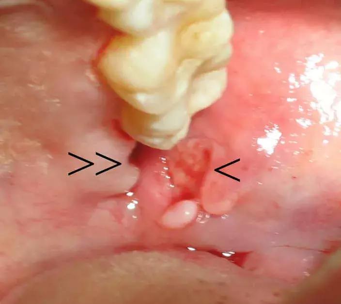 那些不拔智齿的人后来都怎么样了,那些该拔不拔的智齿最后都咋样了