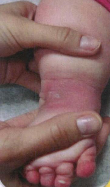 马蹄内翻足的护理有哪些呢,马蹄足内翻矫正支具