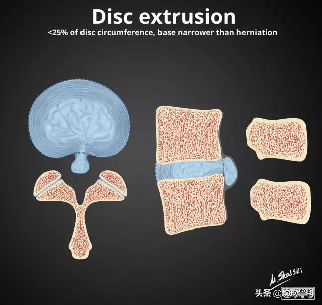 图解腰椎间盘突出,椎间盘髓核膨出图