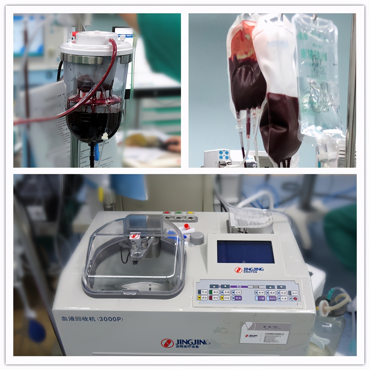 体重45KG，腹腔积血达3000ml，她与死神擦肩而过，靠自己救回自己