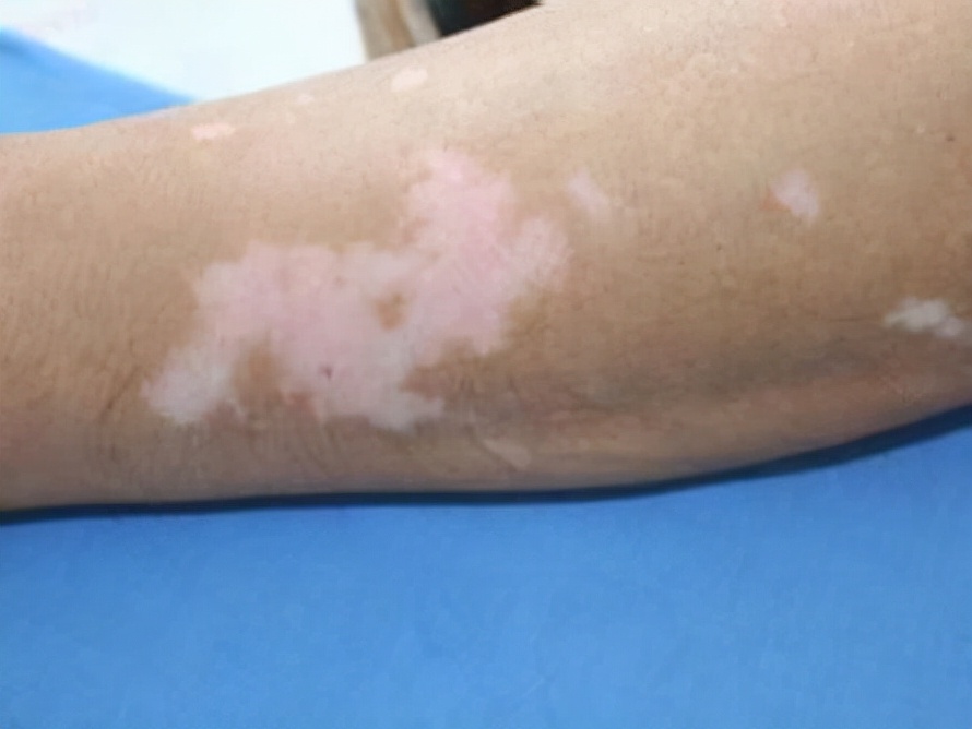 白癜风的常见治疗误区都有哪些,得了白癜风一定要注意这2点