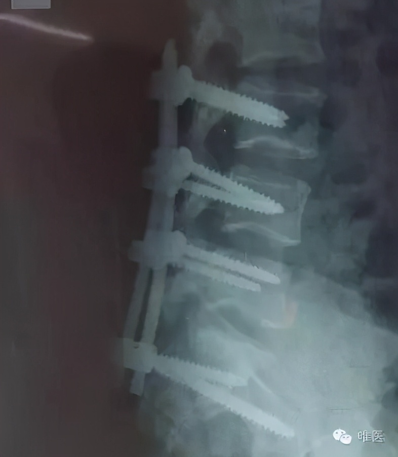 尾骶骨骨折错位突出怎么办,骶骨骨折能手法复位吗