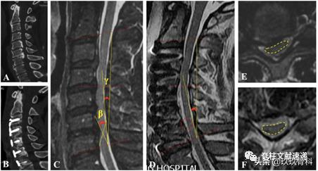 acaf手术适应脊髓型颈椎病吗,acaf术后康复方法