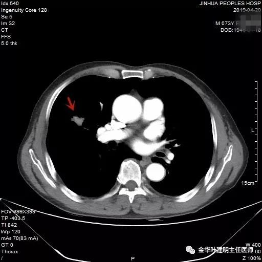 能不能手术,极重度混合性通气功能障碍能治吗