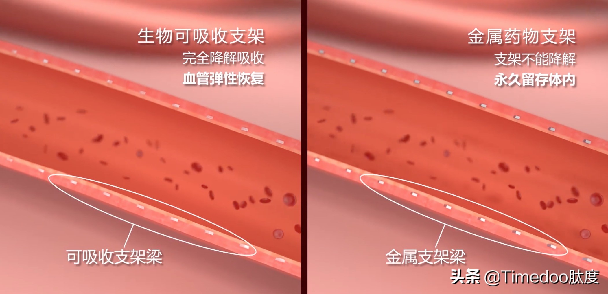 心跳科技的力量|乐普医疗推出首个国产生物可吸收支架
